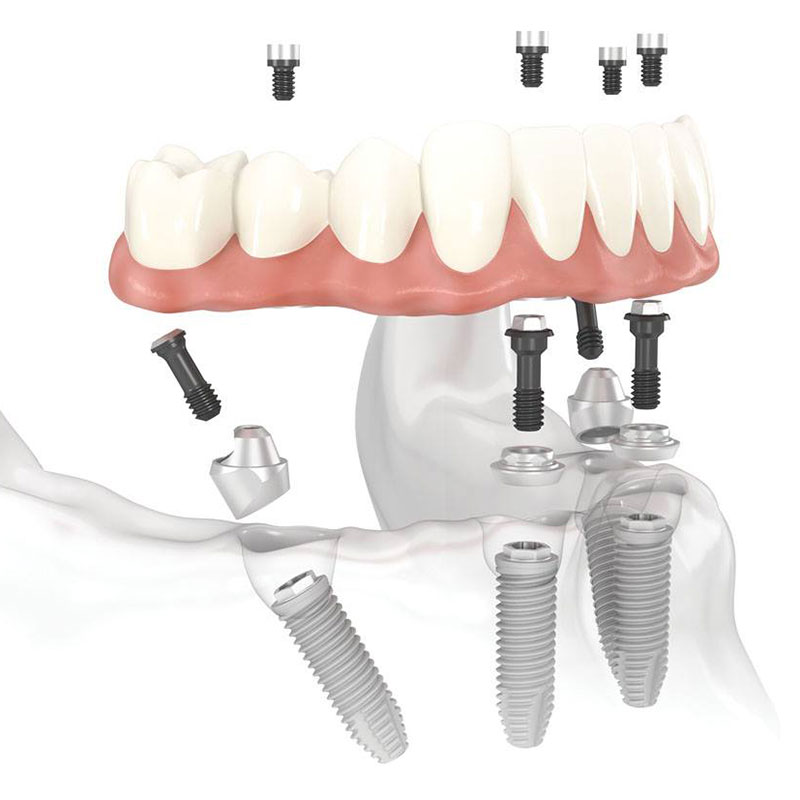 Fixed dentures on implants at Rizzoli Denture Clinic